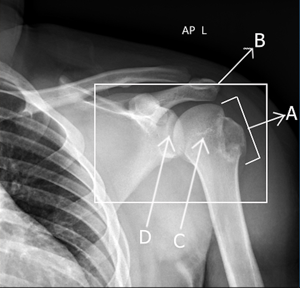 Bilateral Simultaneous Asymmetrical Anterior Shoulder Dislocation With
