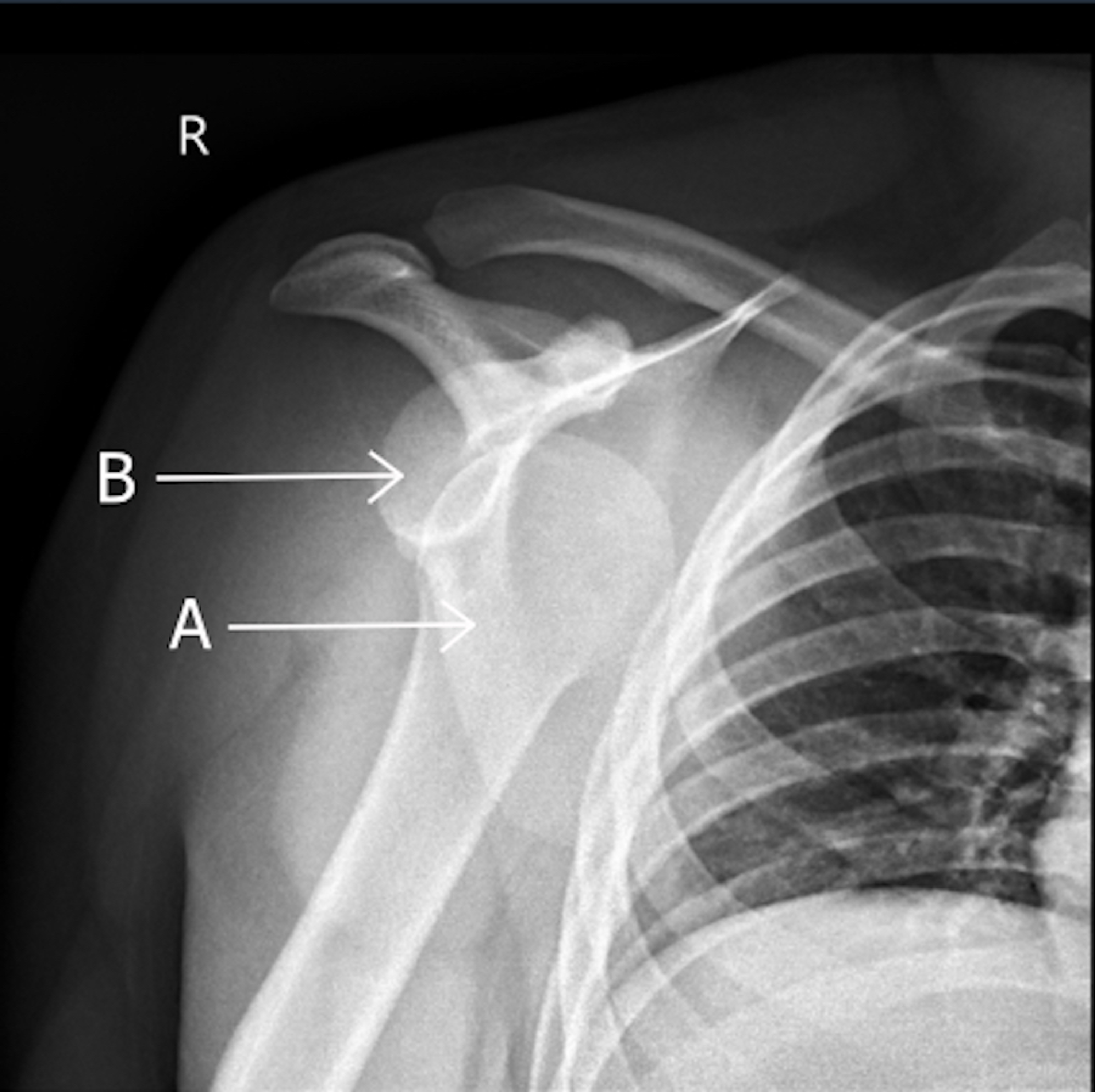 Cureus Bilateral Simultaneous Asymmetrical Anterior Shoulder Dislocation With a Fracture