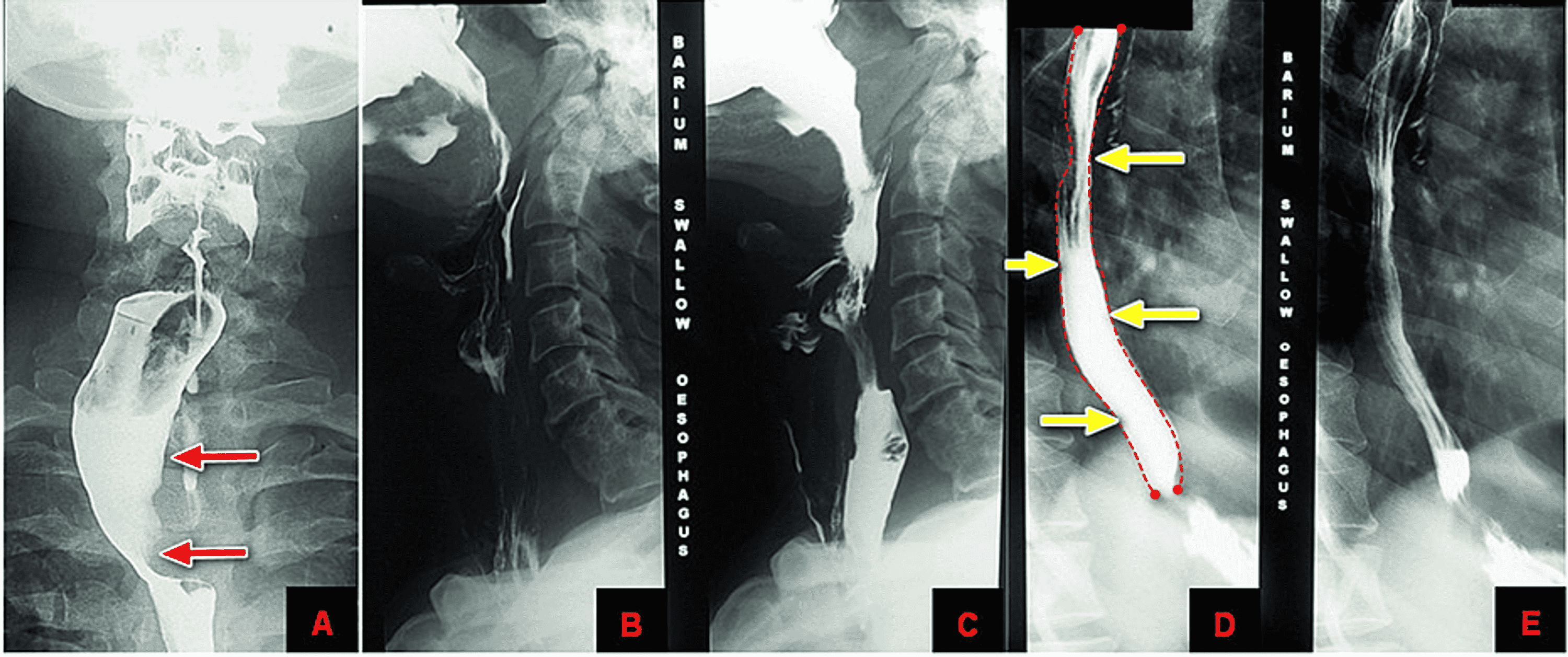 Cureus Isolated Posterior Mediastinal Thyroid Nodule Simulating