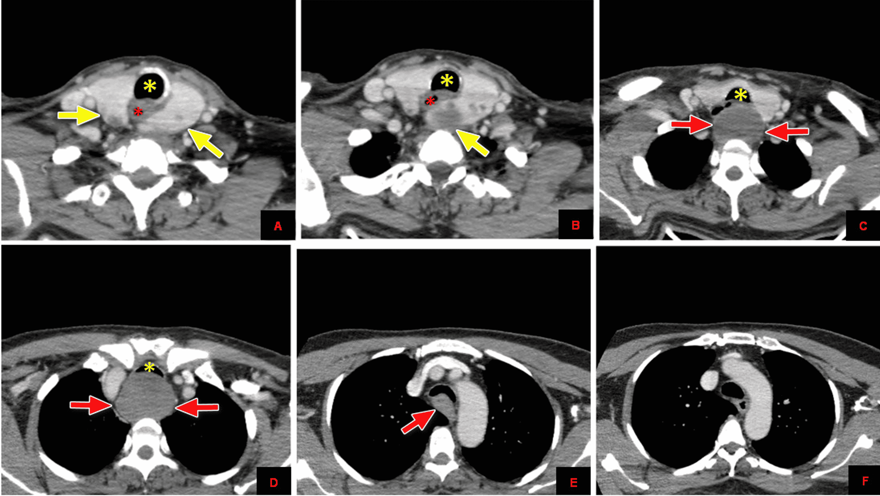 Cureus Isolated Posterior Mediastinal Thyroid Nodule Simulating Esophageal Pathology A Multi 