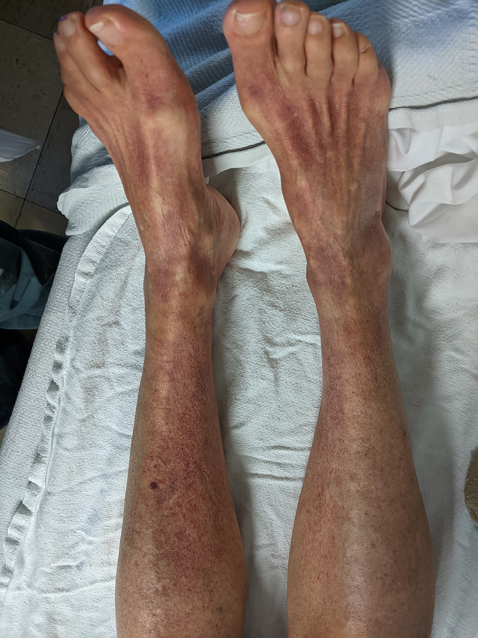 Ecchymosis-over-bilateral-legs