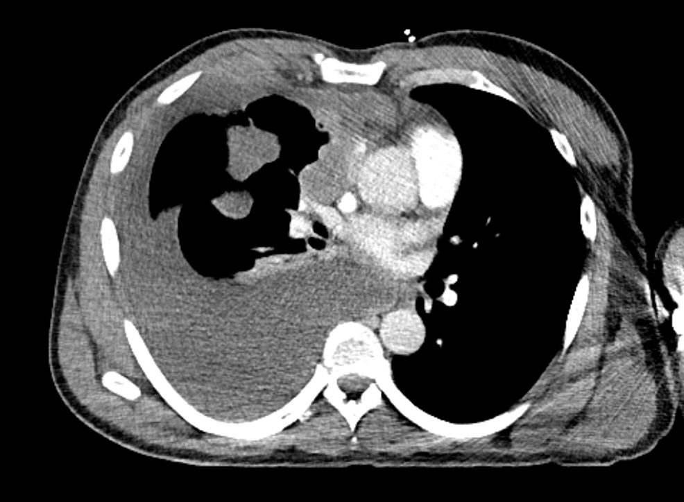CT-chest-with-contrast,-axial-view-