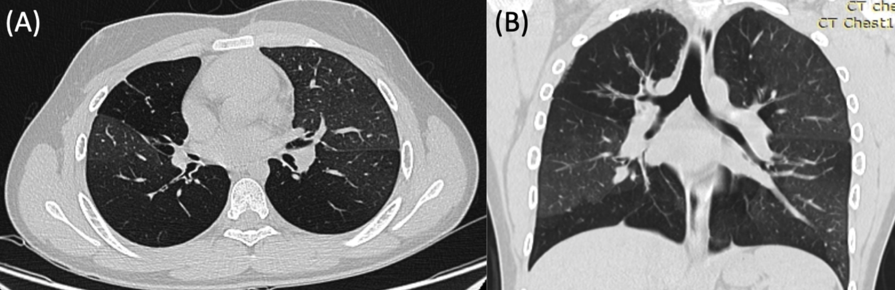 Cureus Mycoplasma pneumoniae and Bronchiolitis Obliterans How a