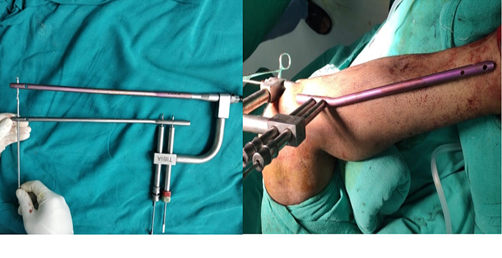 TN-ADVANCED Tibial Nailing System: Suprapatellar Approach - Nail Insertion  with Matthew Graves, MD | Johnson & Johnson Institute