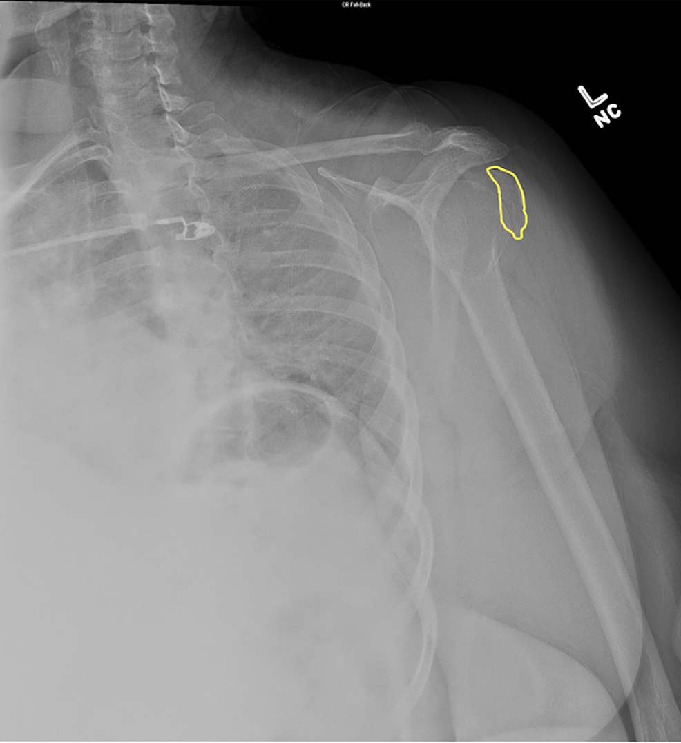 Cureus Anterior Shoulder Dislocation Complicated by HillSachs Lesion