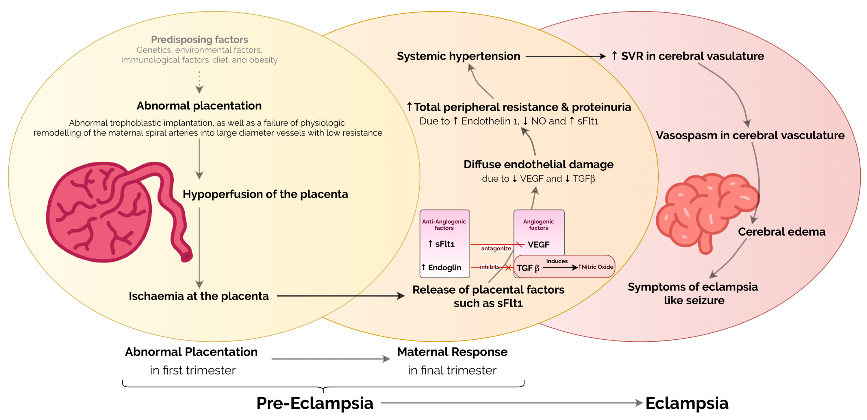 Preeclampsia Pathophysiology Poster By Medcomic Ubicaciondepersonas 