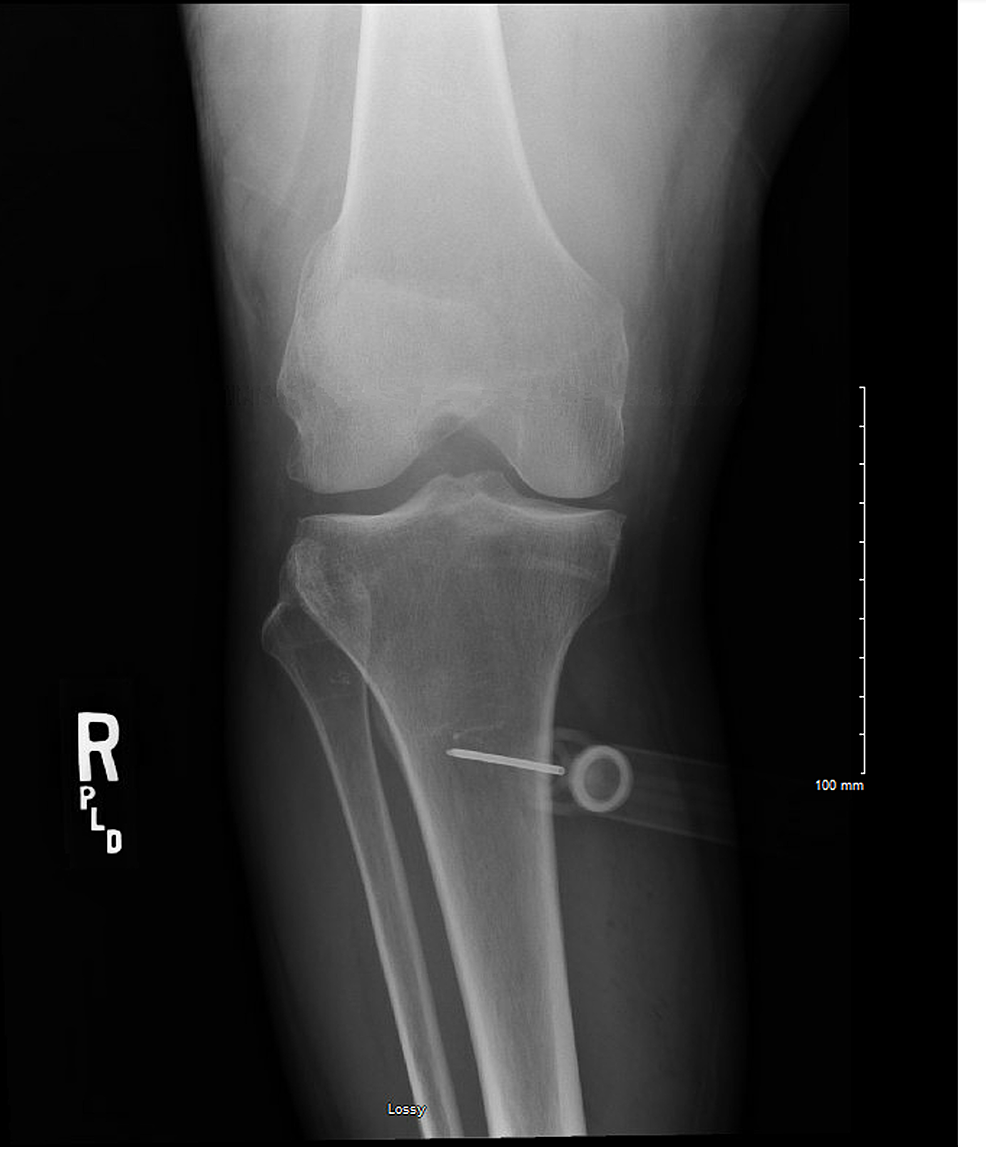 Cureus | A Case of Compartment Syndrome Due to Out-of-Hospital ...