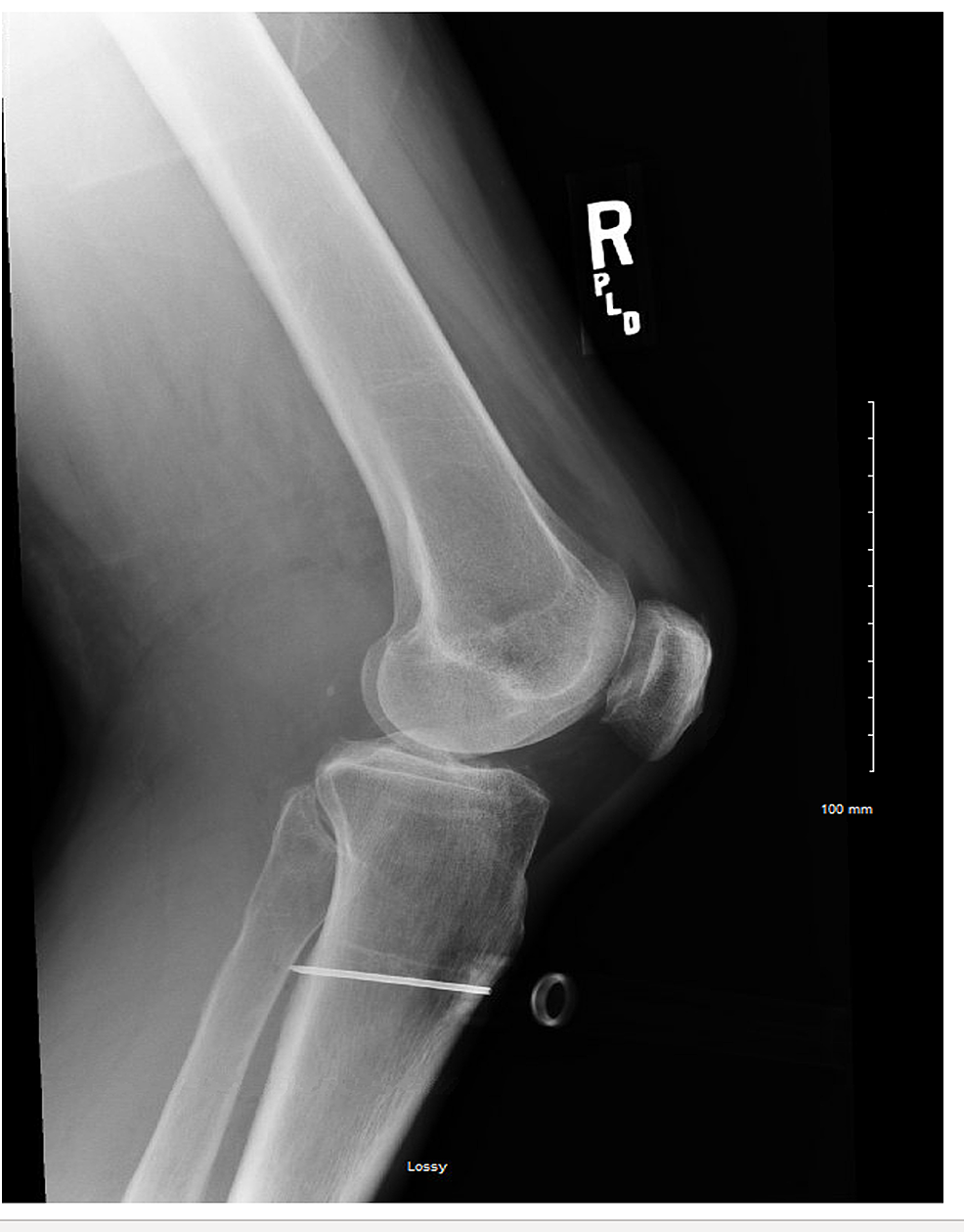 Cureus | A Case of Compartment Syndrome Due to Out-of-Hospital ...