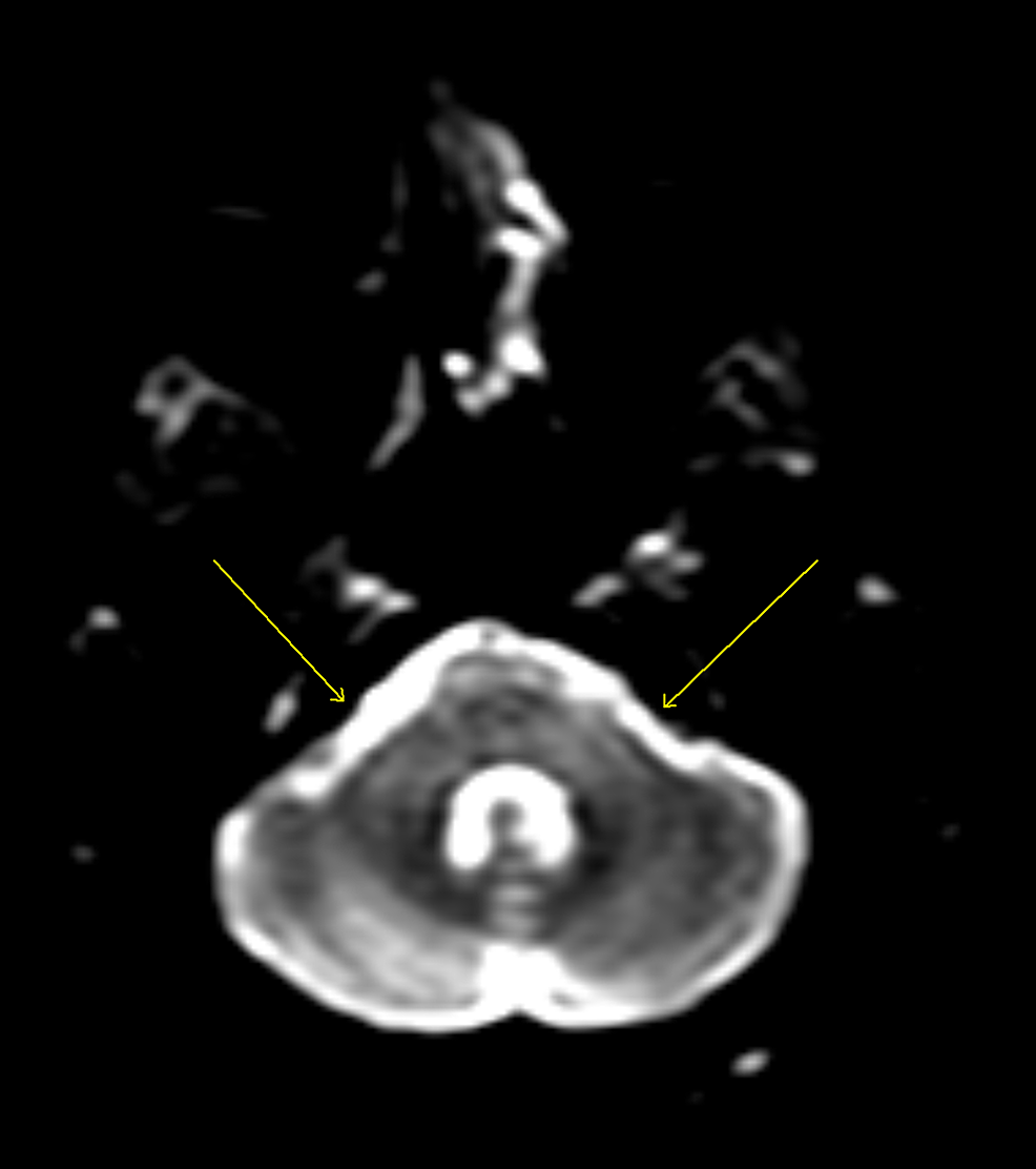 Diffusion-weighted-MRI-when-the-patient-presented.-Arrows-show-both-brachium-(left>right)-of-pons-with-extensive-hyperintense-T2-signal-abnormality-(also-present-over-pericallosal-and-periventricular-white-matter-suggesting-demyelination).