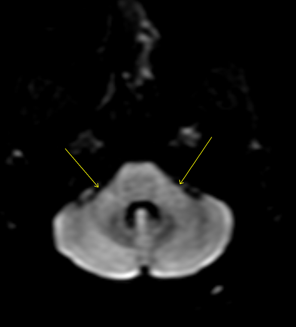 Post-contrast-diffusion-weighted-MRI-when-the-patient-presented.-The-arrows-show-brachium-pontis.