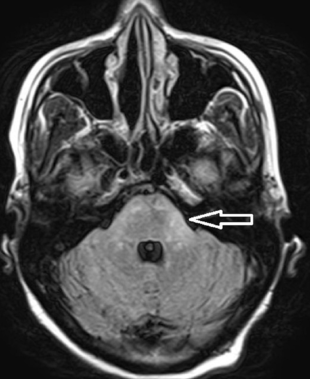 FLAIR-image-with-an-arrow-showing-hyperintense-signal-abnormality-over-left-brachium-pontis