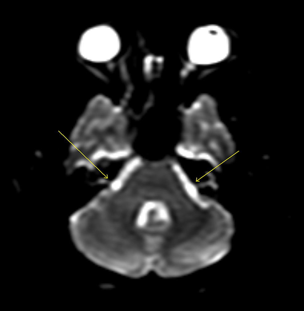 Diffusion-weighted-MRI.-The-arrows-show-marked-improvement-in-the-brachium-pontis-lesion.