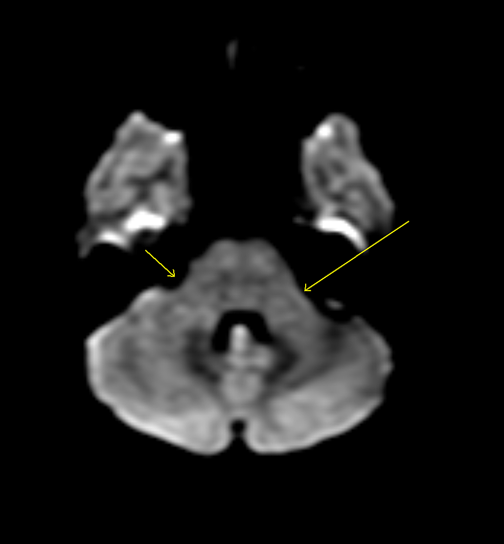Diffusion-weighted-MRI,-post-contrast-phase.-The-arrows-show-marked-improvement-in-the-brachium-pontis-lesion.