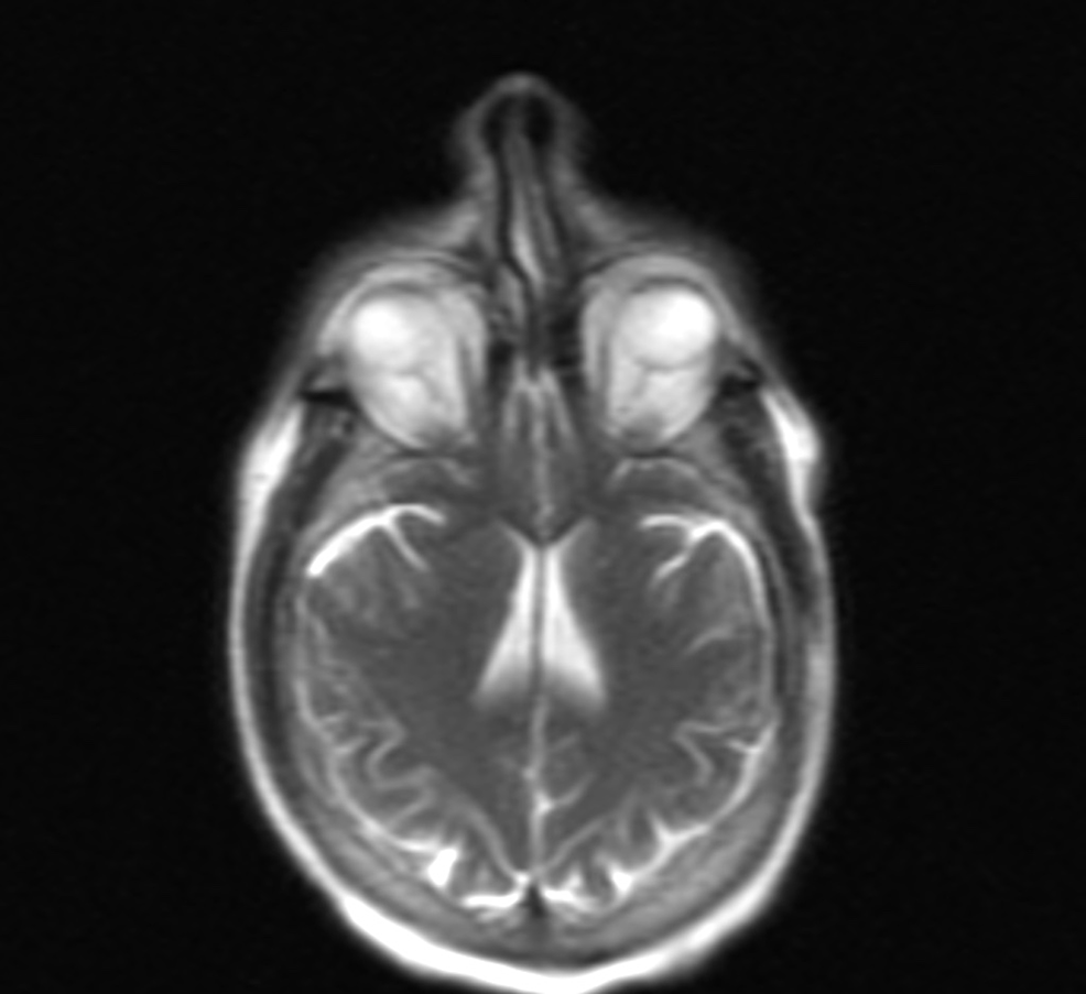 Axial-plane-of-brain-MRI-with-contrast
