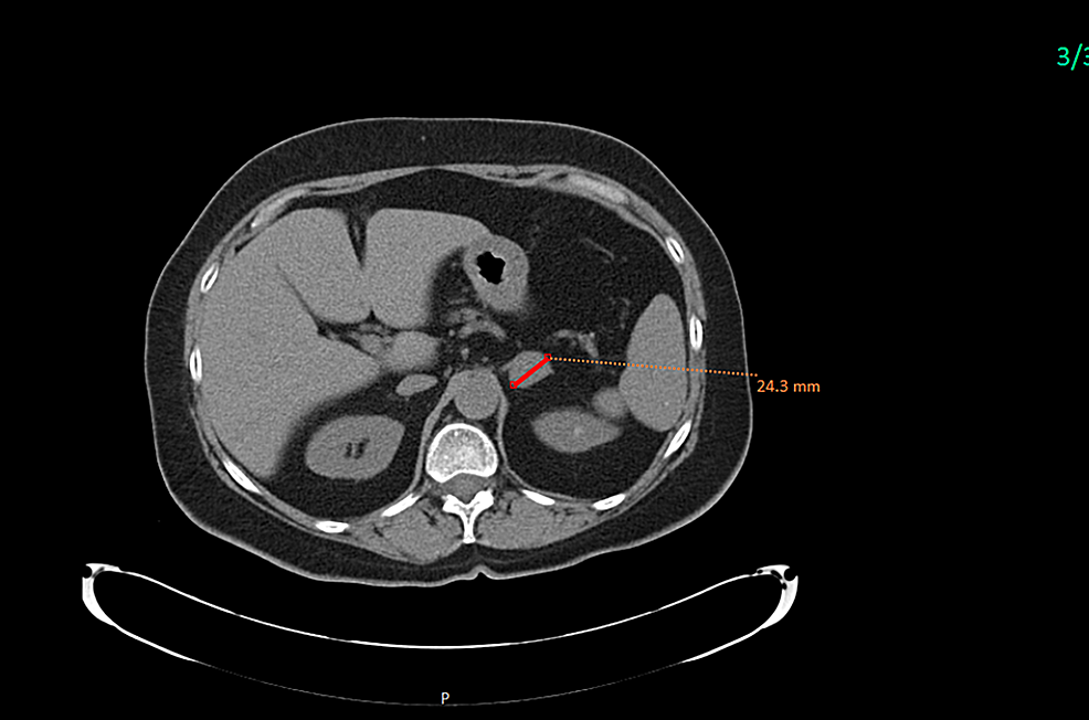 Cureus An Adrenocortical Carcinoma Evolving After Nine Years of
