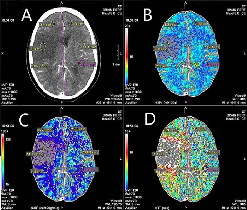 cureus-predictive-value-of-ct-brain-perfusion-studies-in-acute