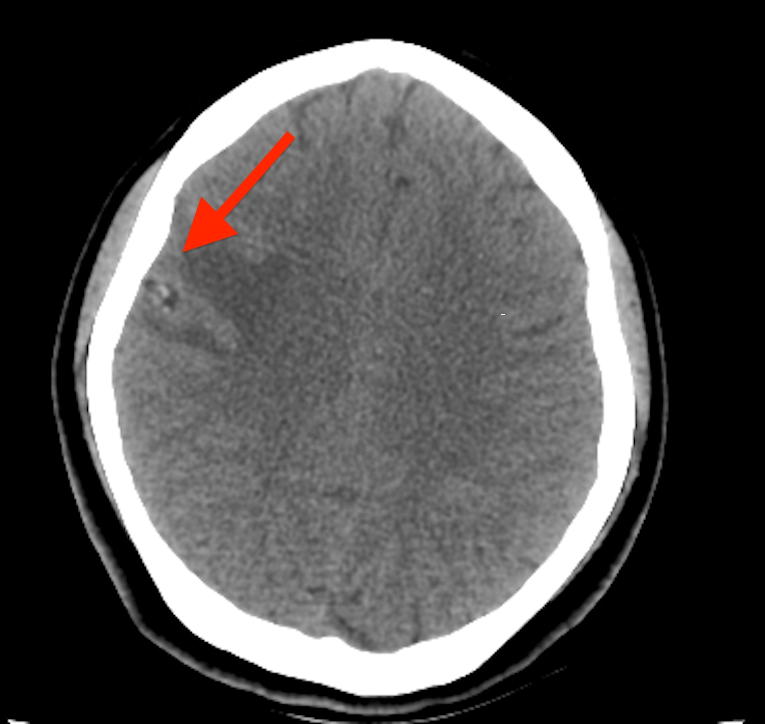 neurocysticercosis