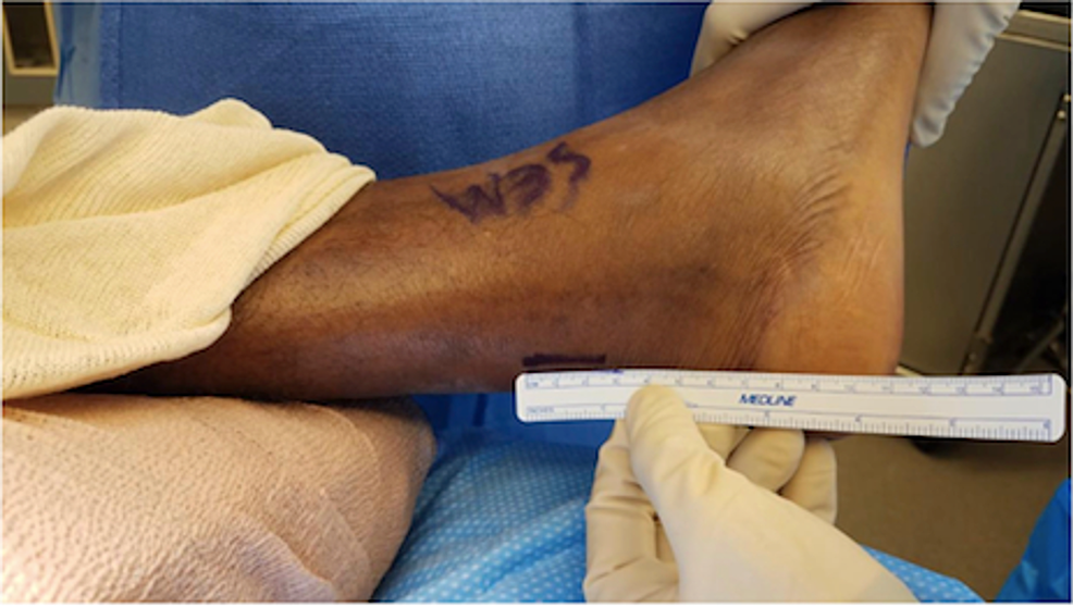 Measurement-of-incision-line-marked-by-a-marking-pen