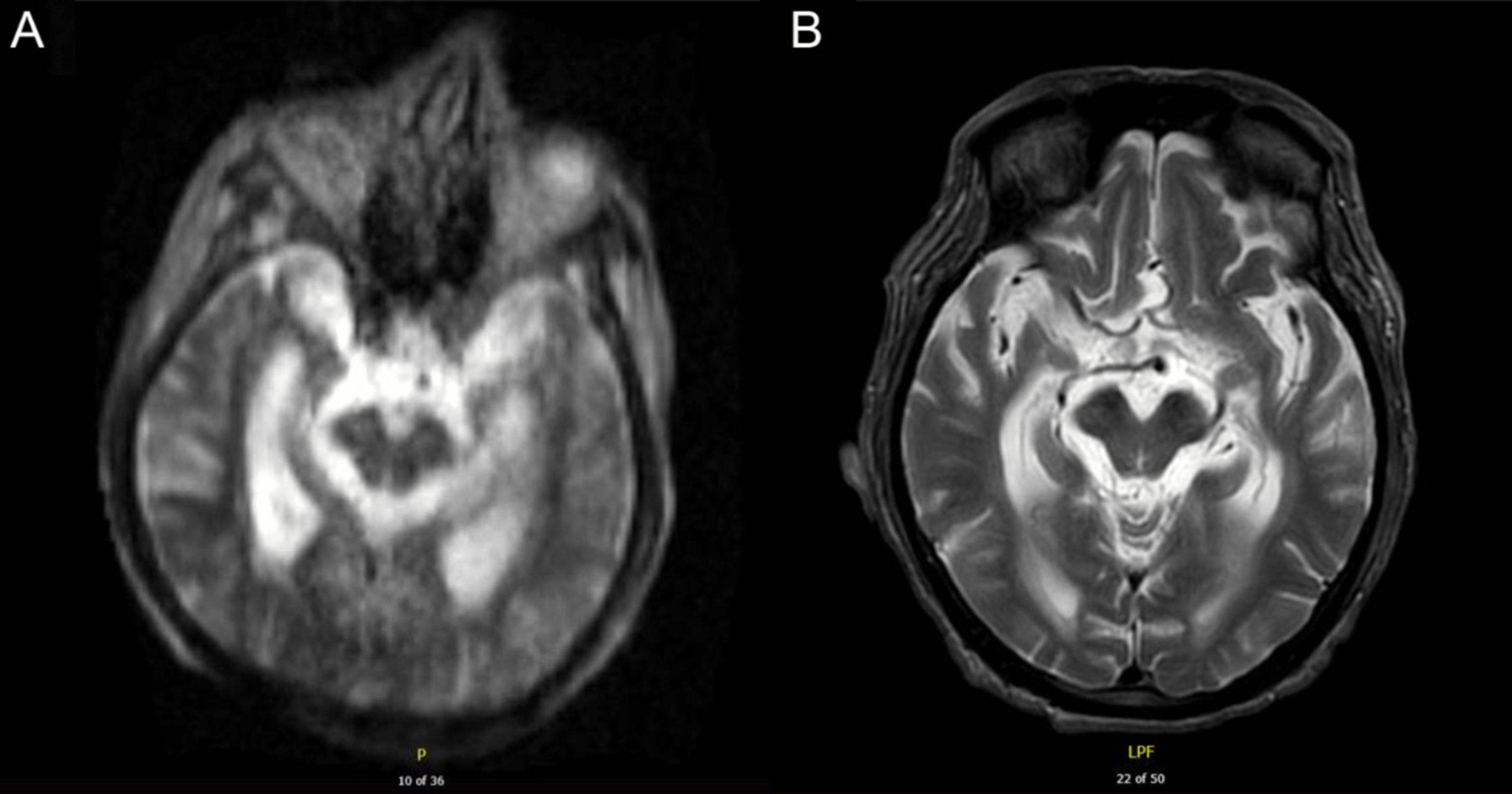 Cureus | MRI at the Bedside: A Case Report Comparing Fixed and Portable Magnetic  Resonance Imaging for Suspected Stroke