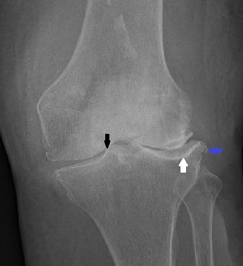 A Rare Case of Septic Knee Arthritis Caused by Clostridium perfringens in a Patient With