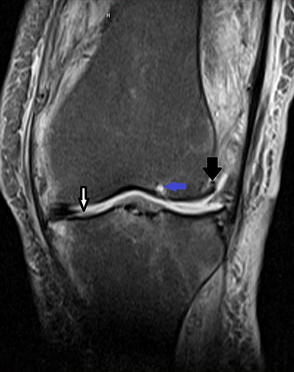 Cureus A Rare Case Of Septic Knee Arthritis Caused By Clostridium Perfringens In A Patient