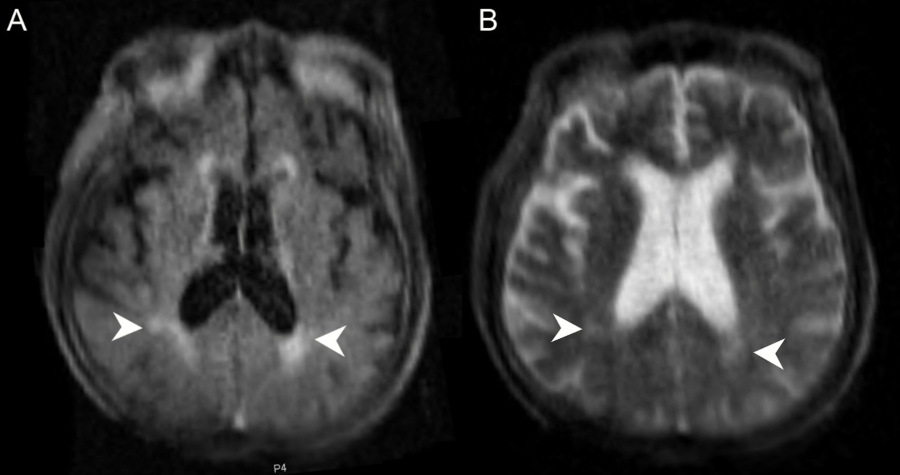 Cureus | MRI at the Bedside: A Case Report Comparing Fixed and Portable Magnetic  Resonance Imaging for Suspected Stroke