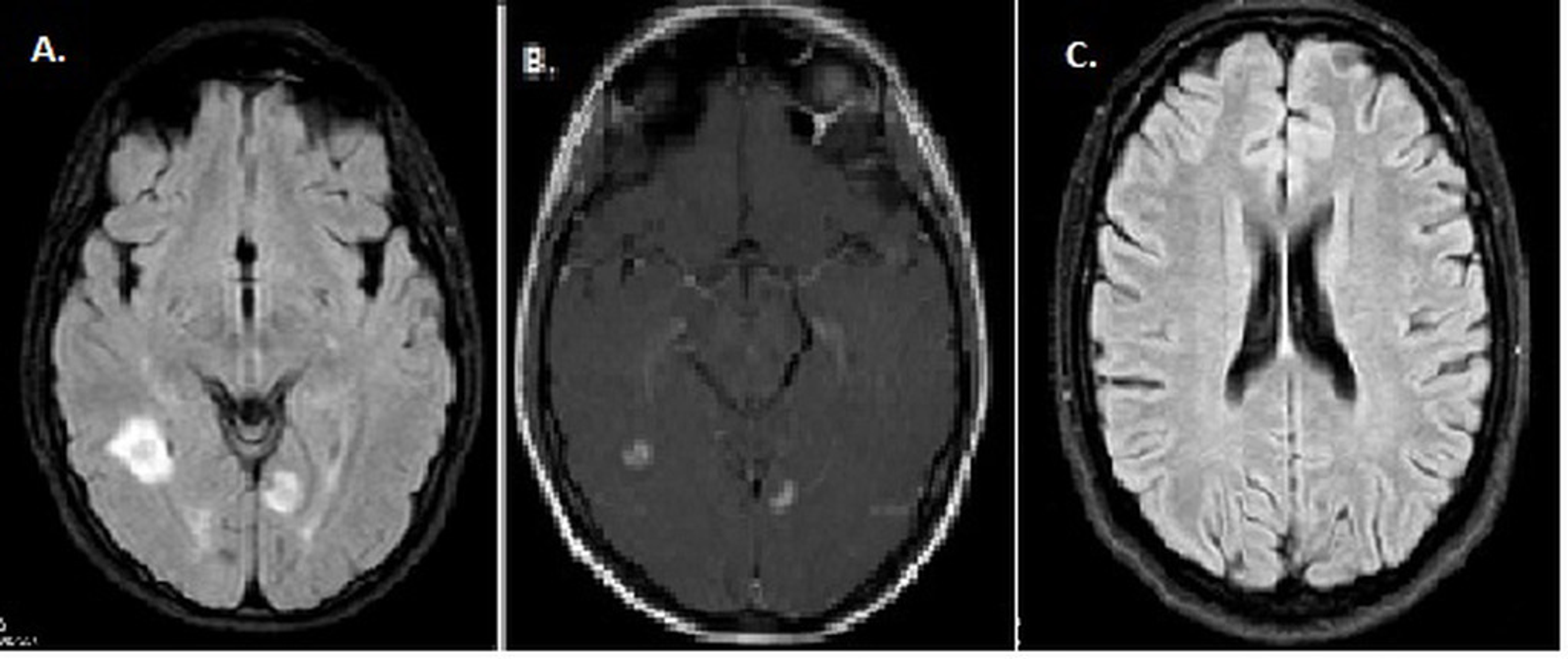 Cureus Demyelinating Disease of the Central Nervous System Concurrent