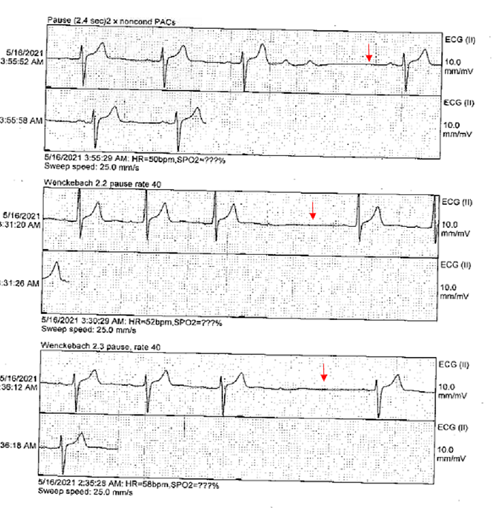 Lyme Carditis Manifesting as Wenckebach Heart Block Cureus