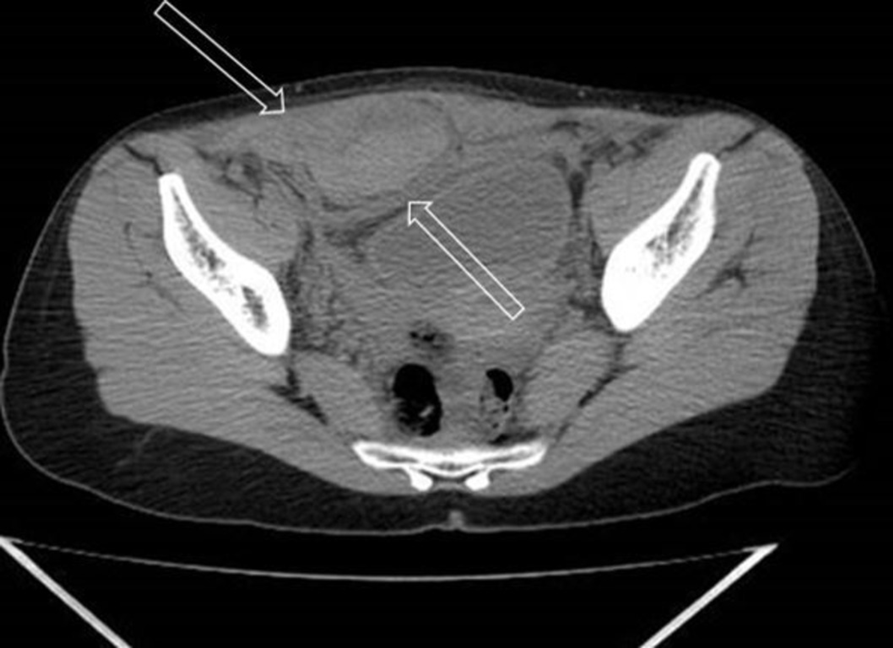 Cureus | Rectus Sheath Hematoma Secondary to Domestic Violence