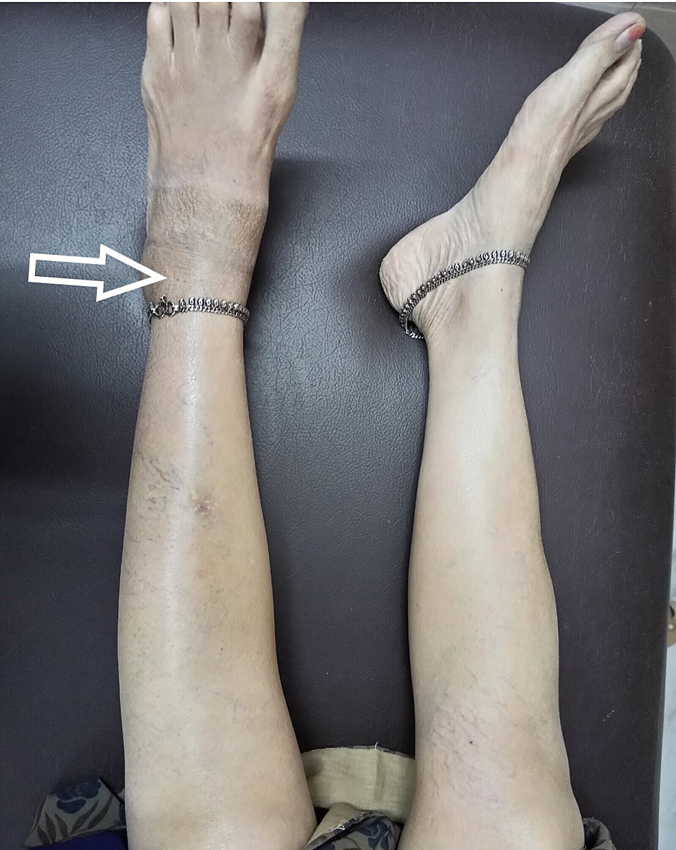 Cureus Ruptured Baker’s Cyst A Diagnostic Dilemma