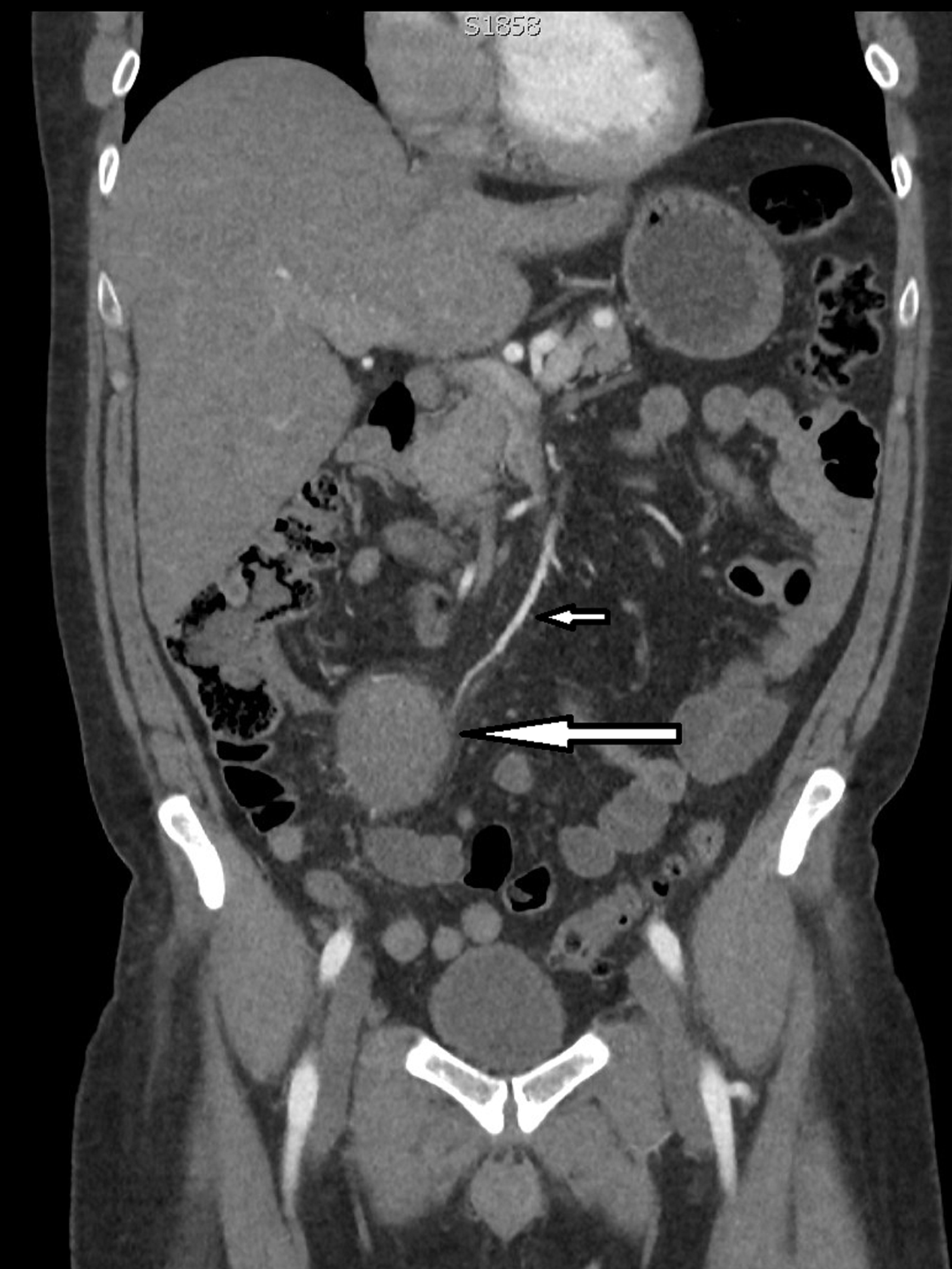 Cureus Endovascular Coil Embolization Of Superior Mesenteric Artery Branch Pseudoaneurysm Cureus Endovascular Coil Embolization Of Superior Mesenteric Artery Branch Pseudoaneurysm