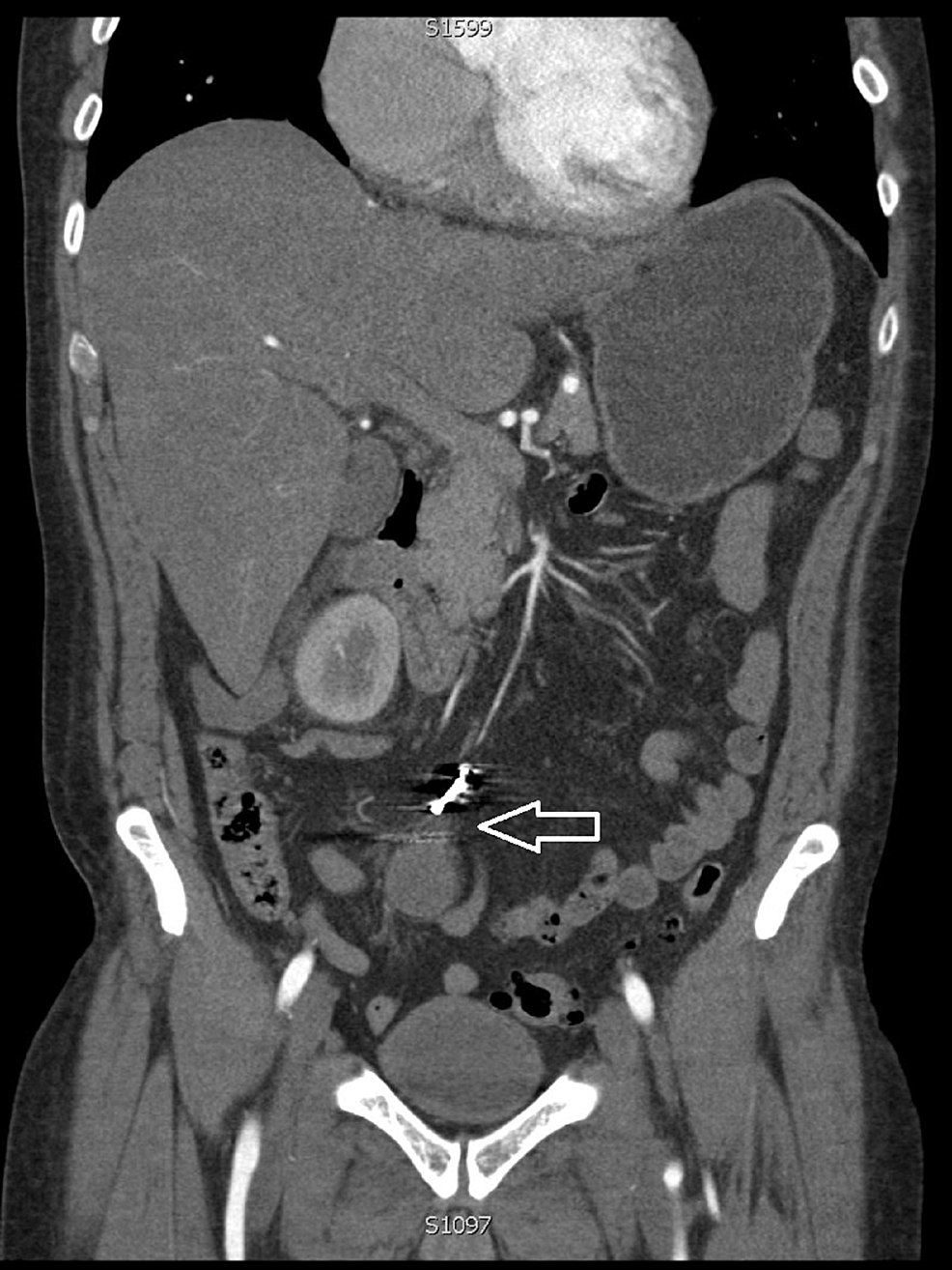 Endovascular Coil Embolization of Superior Mesenteric Artery Branch