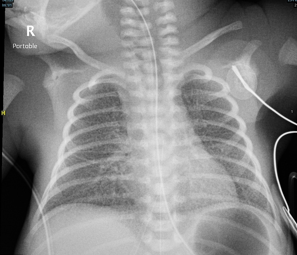 Pulmonary Arterial Hypertension as a Fatal Complication of ...