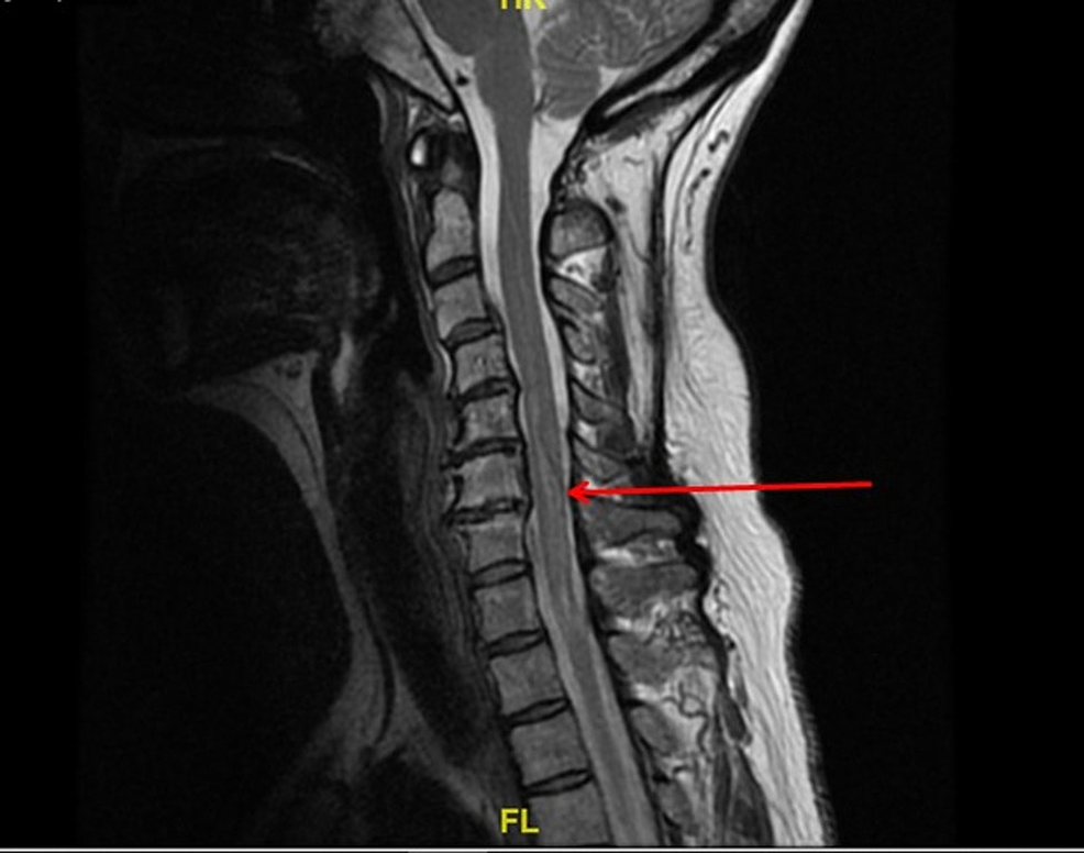 Sagittal,-T2-MRI-of-the-cervical-spine.