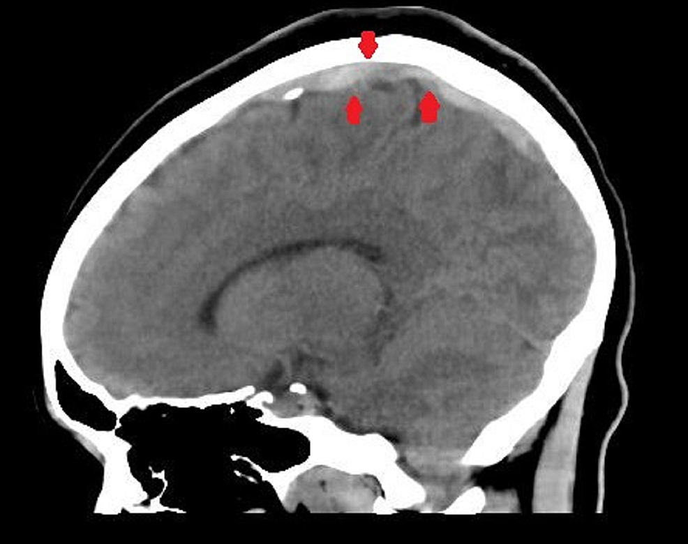 A-sagittal-section-of-brain-CT-scan-showing-a-dense-appearing-superior-sagittal-sinus-suspicious-for-thrombosis-(arrows)