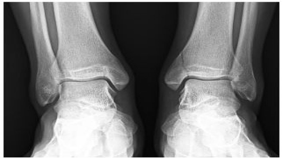 medial malleolus of tibia