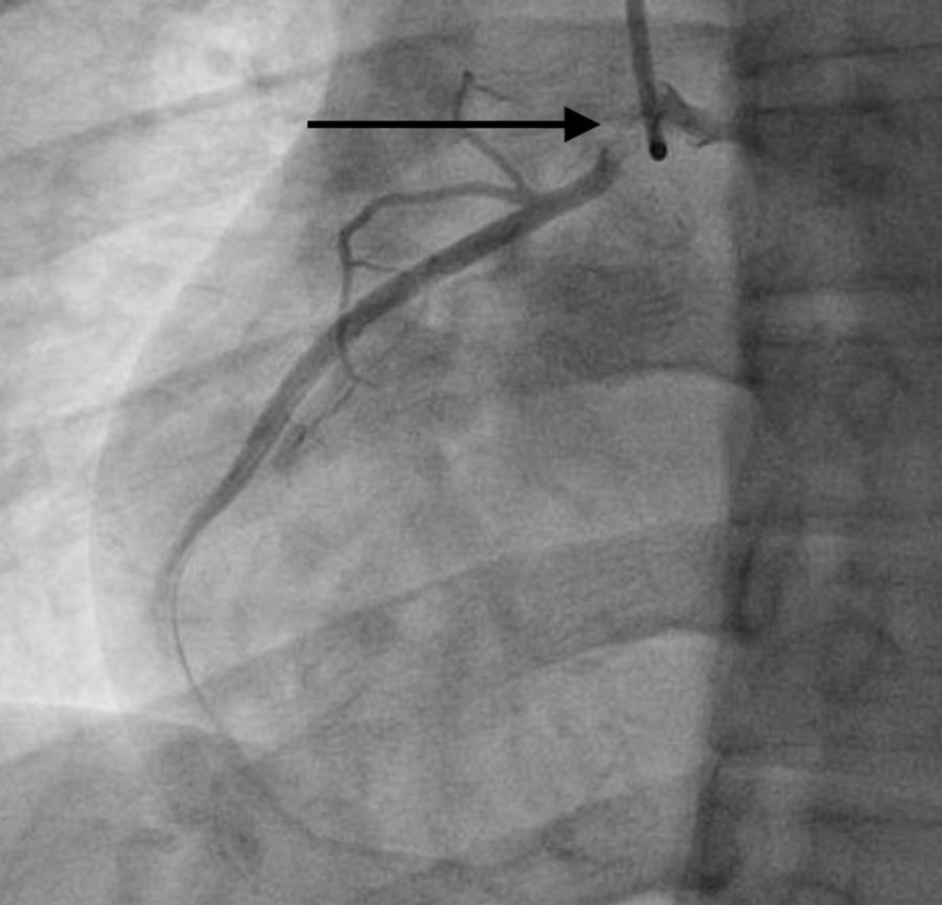 Cureus | Spontaneous Coronary Artery Dissection of an Anomalous Right ...