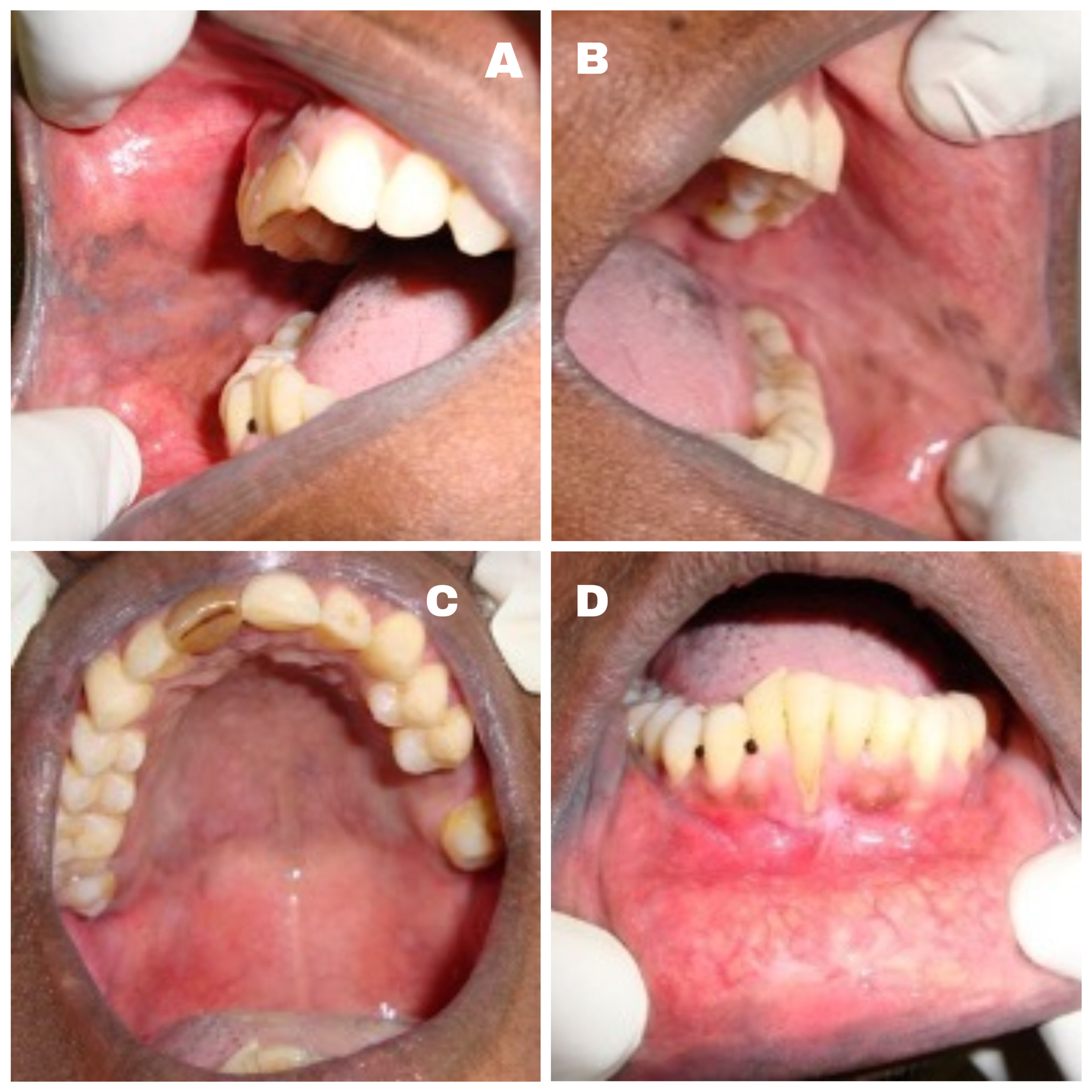 pemphigus vulgaris oral lesions