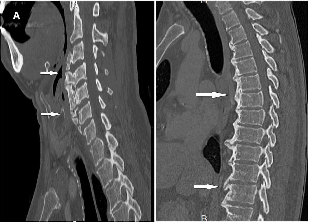 Anterior Osteophytes Cervical Spine