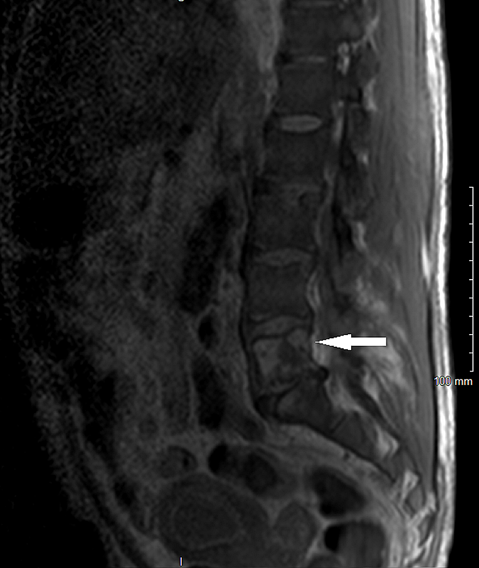 Cureus Brown Tumor With Spine Involvement at Multiple Levels in a