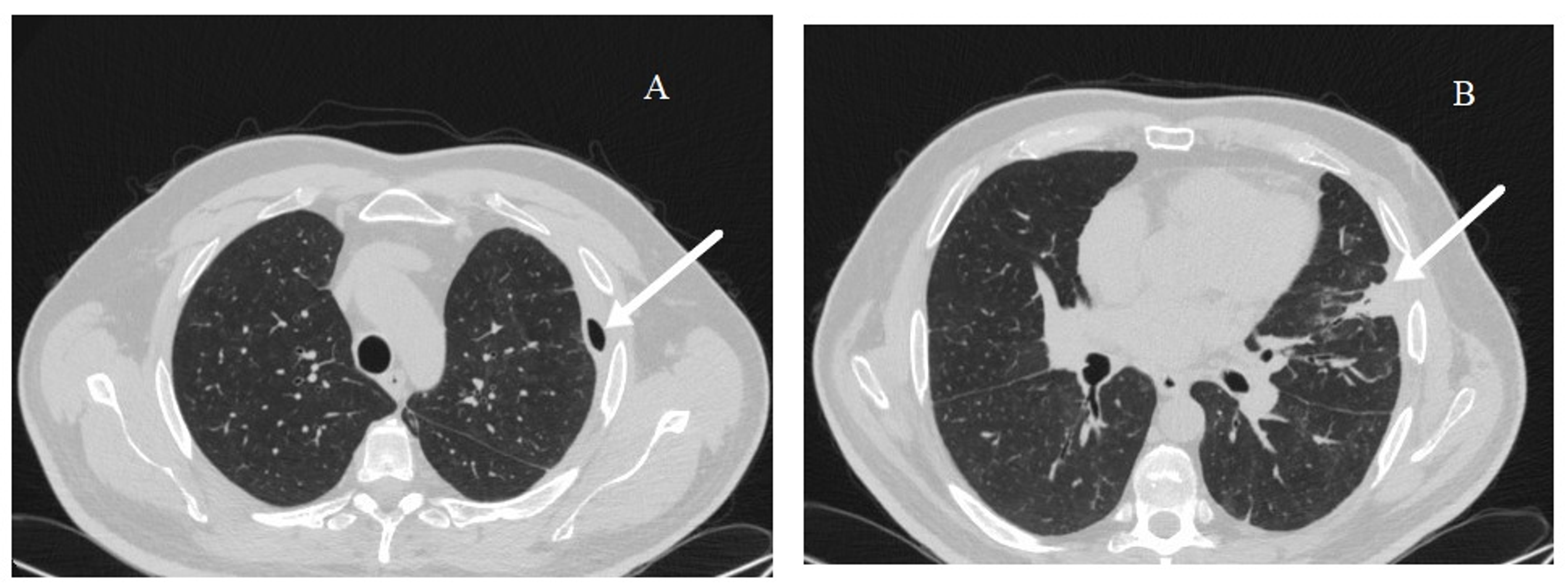 Cureus | Pneumoscrotum Caused by a Bronchopleural Fistula