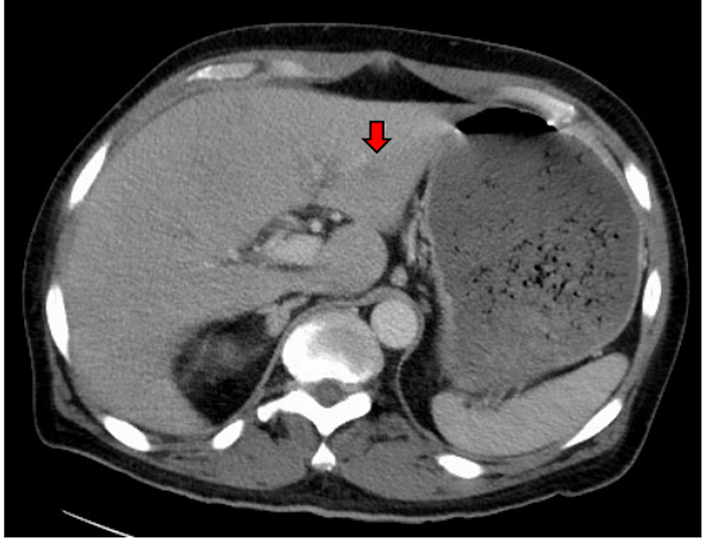 Cureus | Advanced Squamous Cell Carcinoma of Gall Bladder Masquerading ...