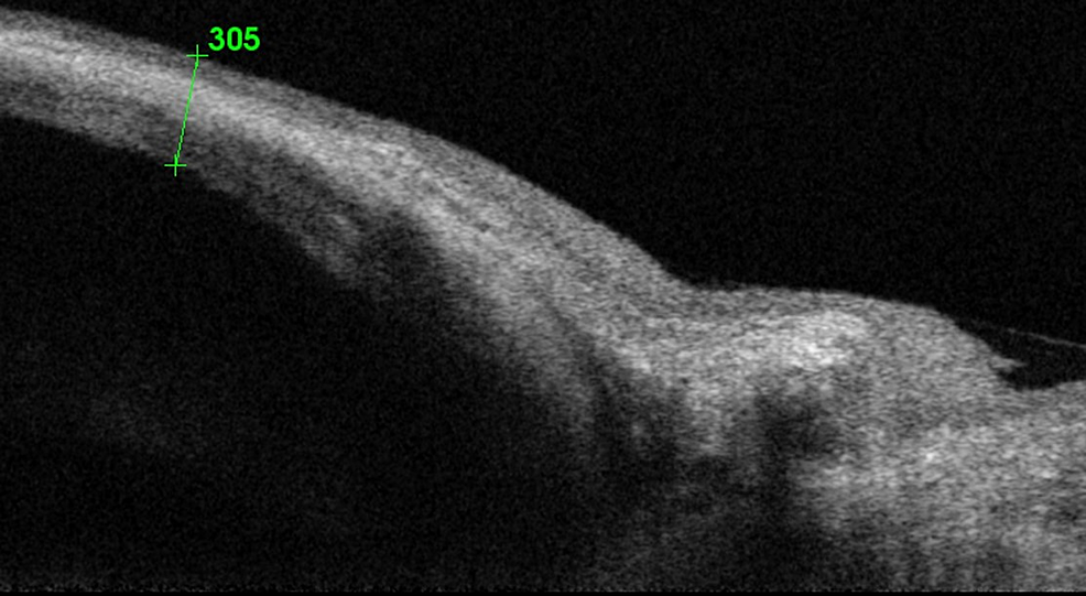 Cureus Spontaneous Trabeculectomy Bleb Reformation and Regain of