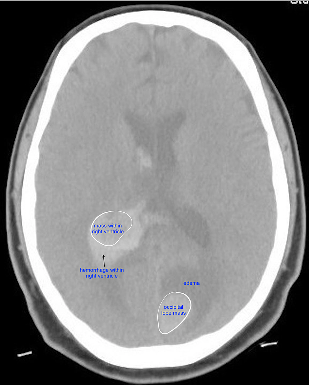 Magnetic resonance imaging. Large intracranial hemorrhage with moderate