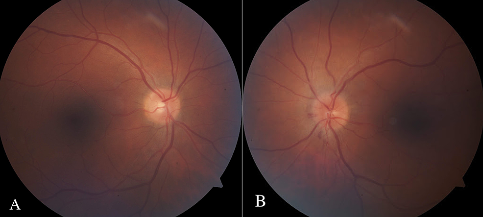 Unilateral Optic Nerve Hypoplasia in a patient desiring surgical treatment  for his exotropia