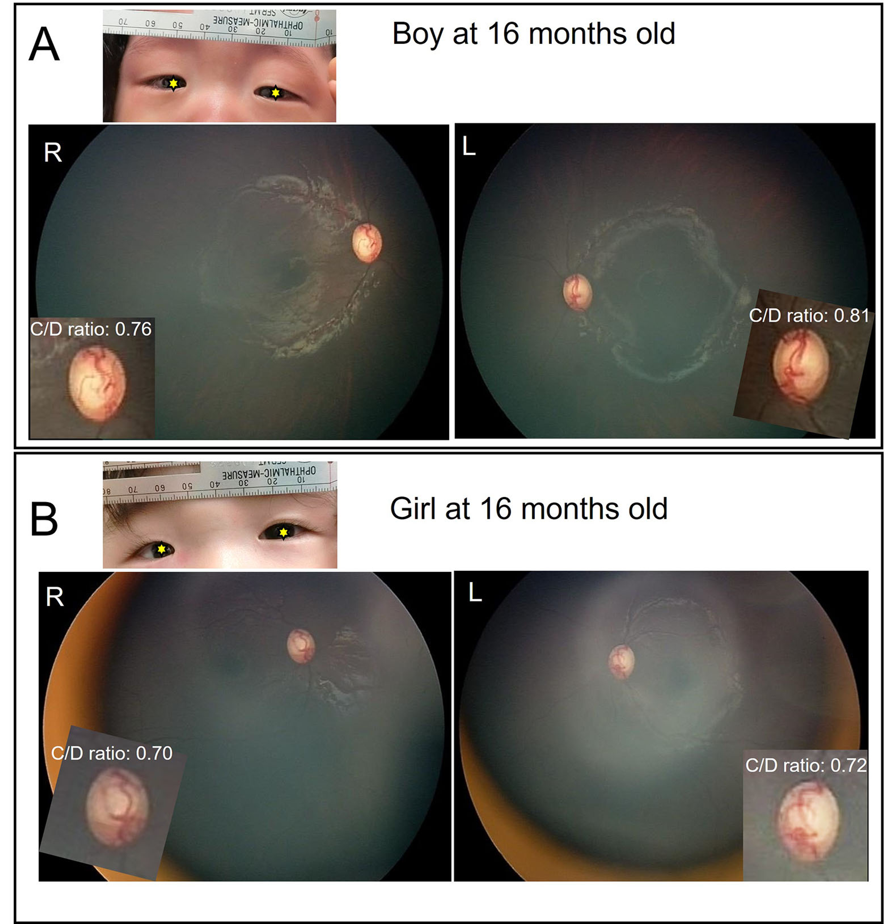 glaucoma in premature babies