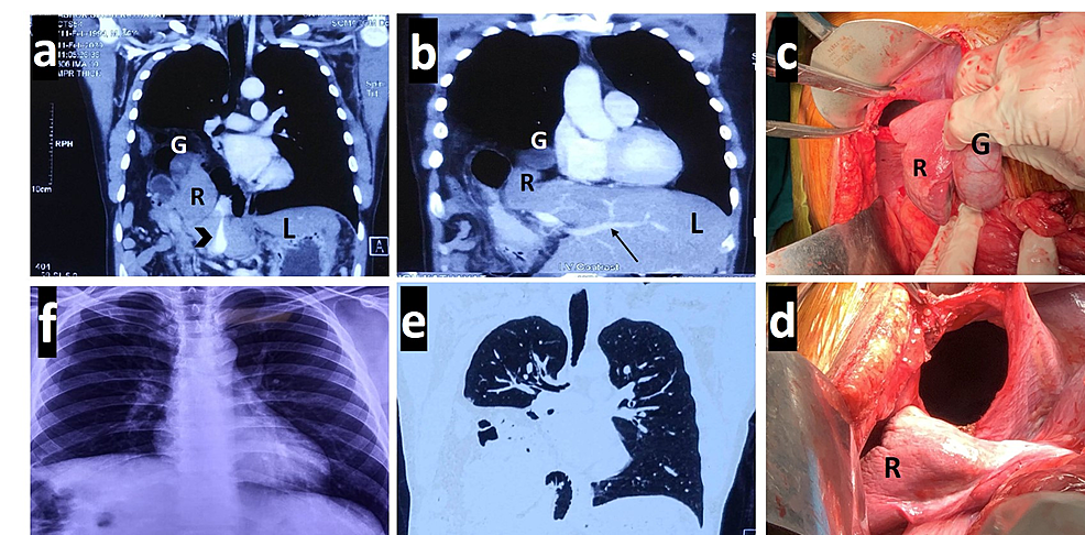 Cureus | Significant Liver Atrophy Due to Vascular Compromise ...