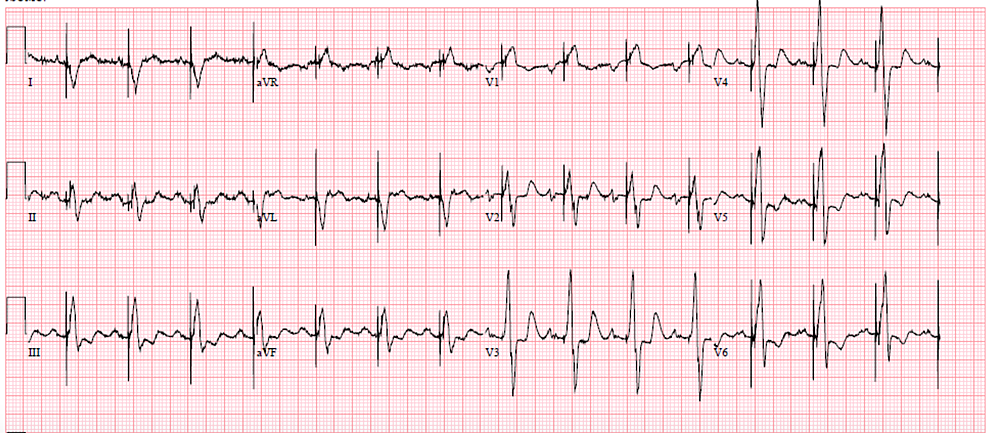 Kearns-Sayre Syndrome With Persistent Ventricular Tachycardia ...