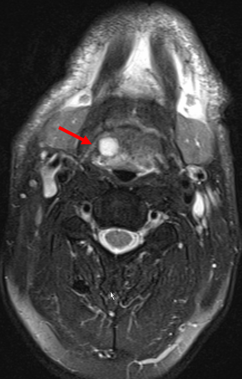 Tongue Root Cyst as a Manifestation of the Variant m.3243A>G | Cureus