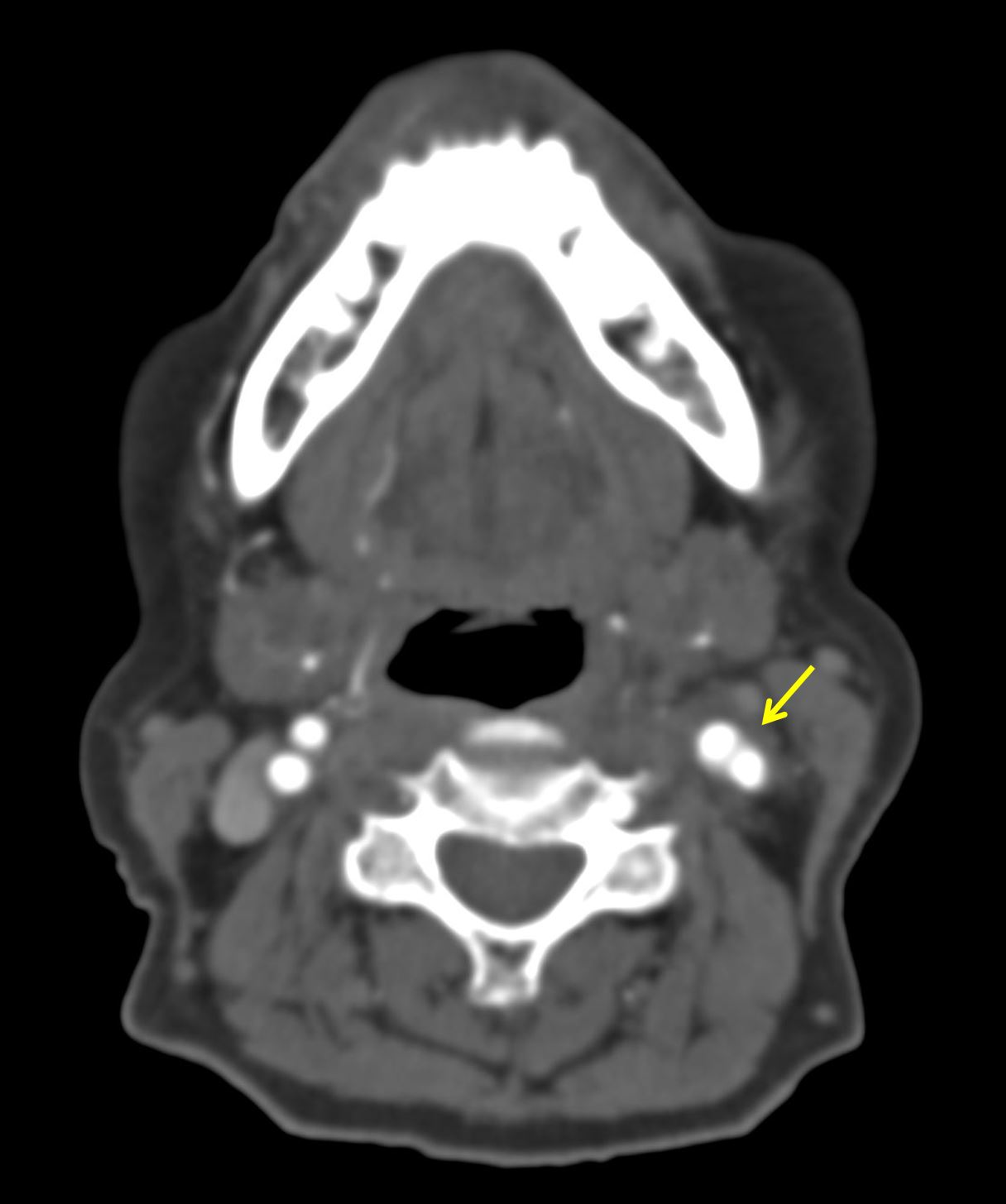 Carotidynia Versus Transient Perivascular Inflammation of the Carotid ...